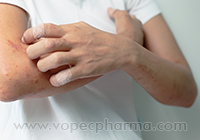   treatment for eczema
