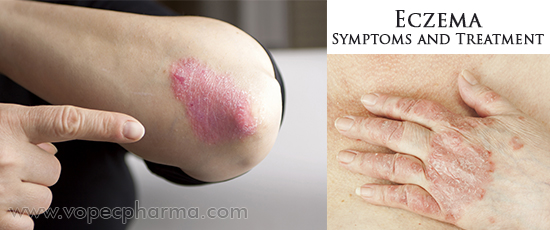 Eczema Symptoms and Treatment