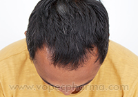    Ayurvedic Home Remedies for Baldness  
