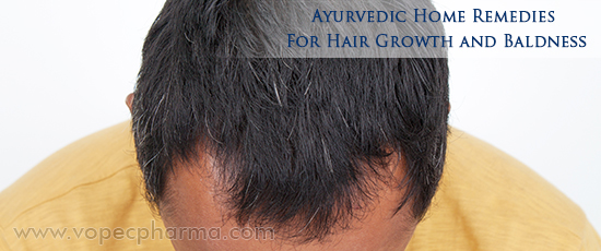 Ayurvedic Home Remedies for Baldness