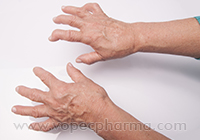   Arthritis & Joint Pain  