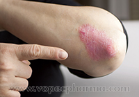  How to Treat Psoriasis at Home  