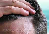 Natural remedies for dandruff in men