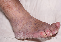 Skin Fungal Infections  