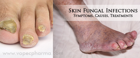 Skin Fungal Infections 