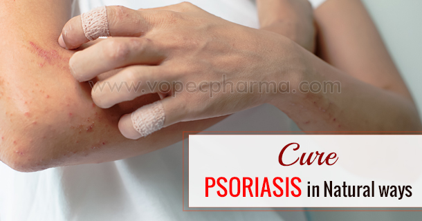 cure-psoriasis-in-natural-ways-blog-size