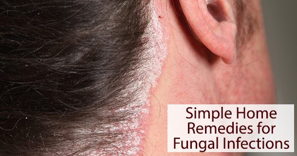 Simple Home Remedies for Fungal Infections